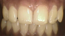 Laser Bleaching Services