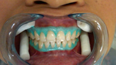 Teeth Bleaching in Mumbai