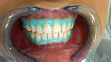 Dental Surgery in Mumbai