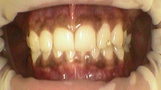 Teeth Bleaching in Mumbai